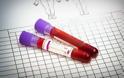 Ελπιδοφόρα ανακοίνωση για τον ιό HIV: Ποιος δεν μεταδίδει τον ιό!