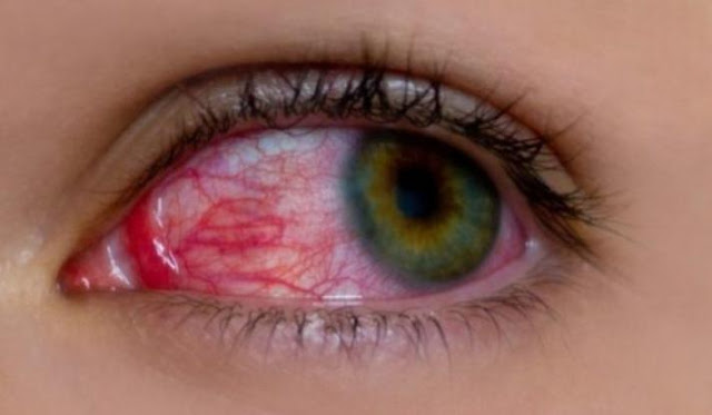 Ραγοειδίτιδα: Τα αίτια και τα συμπτώματα της άγνωστης πάθηση που «απειλεί» την όραση! - Φωτογραφία 1