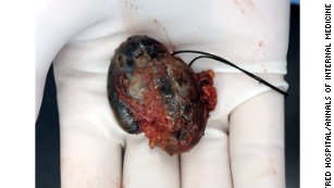 Παλιό τατουάζ αιτία «καρκίνου» σε γυναίκα στην Αυστραλία - Φωτογραφία 2