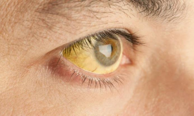 Κίτρινα μάτια: Τι μαρτυρούν για την υγεία σας. - Φωτογραφία 1