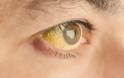 Κίτρινα μάτια: Τι μαρτυρούν για την υγεία σας.