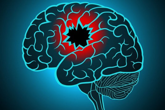 Αυξάνονται οι παράγοντες κινδύνου για εγκεφαλικό – Ποιοι είναι οι βασικοί - Φωτογραφία 1