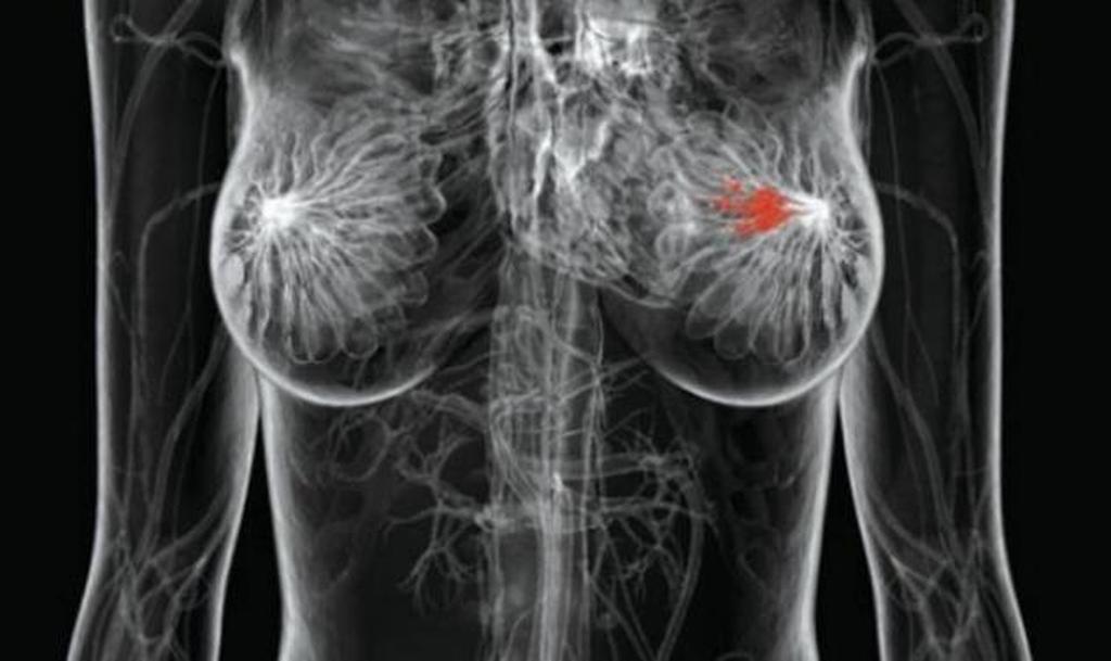 Καρκίνος μαστού: Υποπροϊόν της χοληστερόλης αυξάνει τον κίνδυνο μετάστασης - Φωτογραφία 1