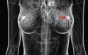 Καρκίνος μαστού: Υποπροϊόν της χοληστερόλης αυξάνει τον κίνδυνο μετάστασης