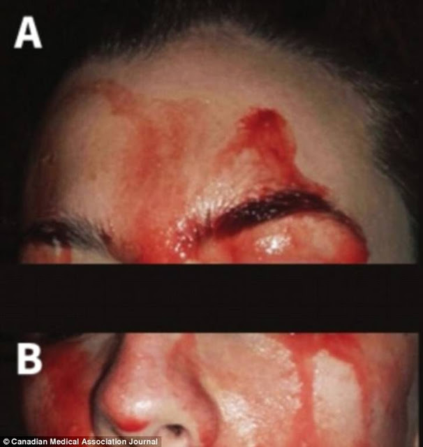 ΣΟΚ! Γυναίκα γεμίζει με αίματα στο πρόσωπο όταν ιδρώνει - ΠΡΟΣΟΧΗ: ΣΚΛΗΡΕΣ ΕΙΚΟΝΕΣ - Φωτογραφία 2
