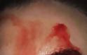 ΣΟΚ! Γυναίκα γεμίζει με αίματα στο πρόσωπο όταν ιδρώνει - ΠΡΟΣΟΧΗ: ΣΚΛΗΡΕΣ ΕΙΚΟΝΕΣ - Φωτογραφία 1