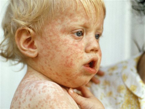 Ο πρώτος θάνατος από ιλαρά σε παιδί 11 μηνών! Συναγερμός στο ΚΕΕΛΠΝΟ - Φωτογραφία 1