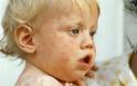 Ο πρώτος θάνατος από ιλαρά σε παιδί 11 μηνών! Συναγερμός στο ΚΕΕΛΠΝΟ