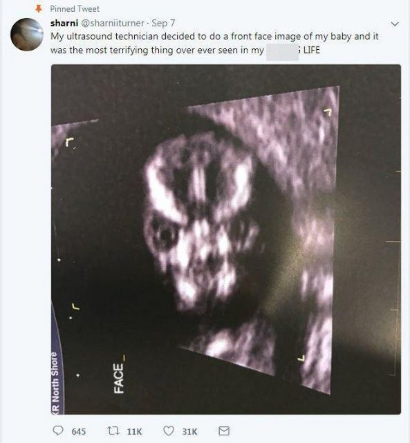 Δεν θα κάνω έκτρωση: Η απόφαση μίας μητέρας μετά τον τρομακτικό υπέρηχο - Φωτογραφία 2