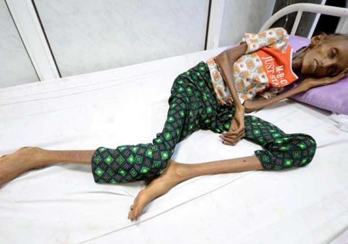 ΟΗΕ: Σοκαριστική η κατάσταση στην Υεμένη - Φωτογραφία 1