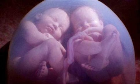 Επιστημονικό παράδοξο: Έμεινε έγκυος ενώ ήταν ήδη έγκυος - Φωτογραφία 1