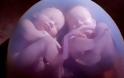 Επιστημονικό παράδοξο: Έμεινε έγκυος ενώ ήταν ήδη έγκυος