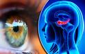 Αλτσχάιμερ: Το σημάδι στα μάτια που μπορεί να είναι πρώιμο σύμπτωμα.