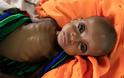 Ο ΟΗΕ προειδοποιεί για μεγάλο λιμό με εκατομμύρια θύματα στην Υεμένη
