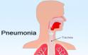Τι είναι η πνευμονία, ποιοι οι τύποι και ποια τα συμπτώματα; Τι να κάνετε για να μην ξαναπάθετε πνευμονία; - Φωτογραφία 2