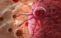Καρκίνος του στομάχου: Ποια τα απλά συμπτώματα που πρέπει να προσέχετε