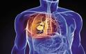 Η Χρόνια Αποφρακτική Πνευμονοπάθεια,αποτελεί την 5η αιτία θανάτου παγκοσμίως.