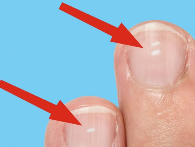 Τι δείχνουν τα λευκά σημάδια στα νύχια για την υγεία μας; - Φωτογραφία 2