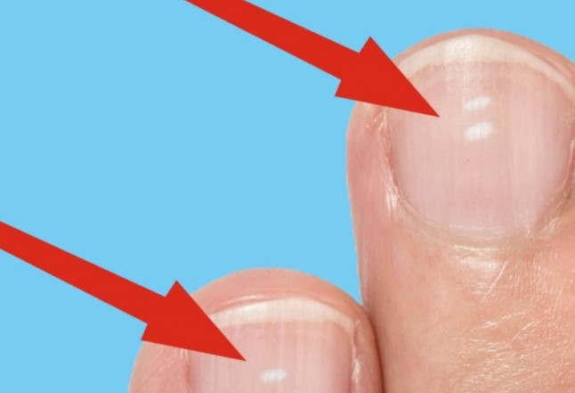 Τι δείχνουν τα λευκά σημάδια στα νύχια για την υγεία μας; - Φωτογραφία 1