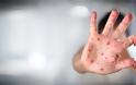 477 κρούσματα ιλαράς- Δεν έχουν εμβολιαστεί ακόμα και γιατροί- νσοηλευτές