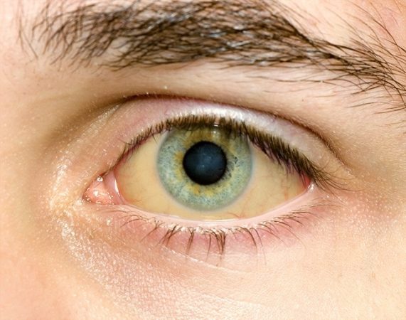 Τι προκαλεί το κιτρίνισμα των ματιών; - Φωτογραφία 1