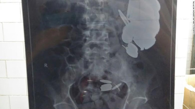 Ινδία: Γιατροί αφαίρεσαν εκατοντάδες κέρματα και καρφιά από το στομάχι ενός άνδρα - Φωτογραφία 2
