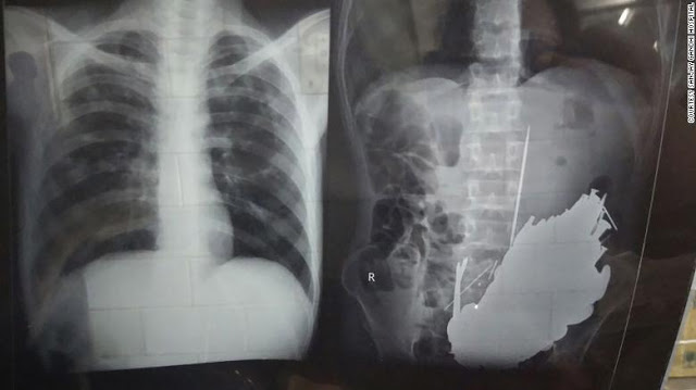 Ινδία: Γιατροί αφαίρεσαν εκατοντάδες κέρματα και καρφιά από το στομάχι ενός άνδρα - Φωτογραφία 3