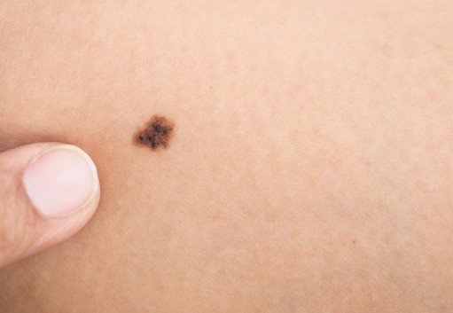 Ελιές στο δέρμα: Αυτά είναι τα 5 σημάδια που δείχνουν κίνδυνο για καρκίνο - Φωτογραφία 1