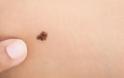 Ελιές στο δέρμα: Αυτά είναι τα 5 σημάδια που δείχνουν κίνδυνο για καρκίνο