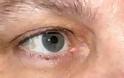 Έχετε αυτά τα σημάδια στα μάτια; - Τι προβλήματα αποκαλύπτουν για την υγεία σας - Φωτογραφία 1