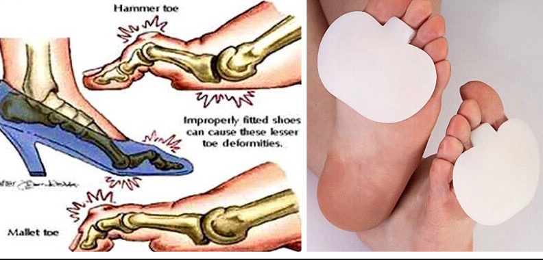 N9 ΝΑΡΘΗΚΑΣ Orthogel Πτώση μεταταρσίου   N9 - Φωτογραφία 9