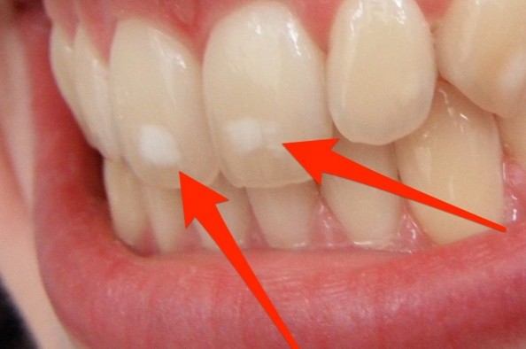 Πού οφείλονται αυτά τα λευκά σημάδια στα δόντια – Τι πρέπει να κάνετε - Φωτογραφία 1