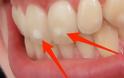 Πού οφείλονται αυτά τα λευκά σημάδια στα δόντια – Τι πρέπει να κάνετε