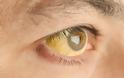 Κίτρινα μάτια: Προσοχή στην ανεβασμένη χολερυθρίνη – Τι πρέπει να ξέρετε