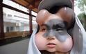 Γυναίκα ζει με 4 μπαλόνια στο πρόσωπό της  - Ο λόγος που έβαλε τα εμφυτεύματα είναι συγκλονιστικος