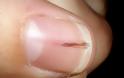 Δείτε τα σημάδια δυσλειτουργίας της καρδιάς που φαίνεται στα νύχια... [photos] - Φωτογραφία 3