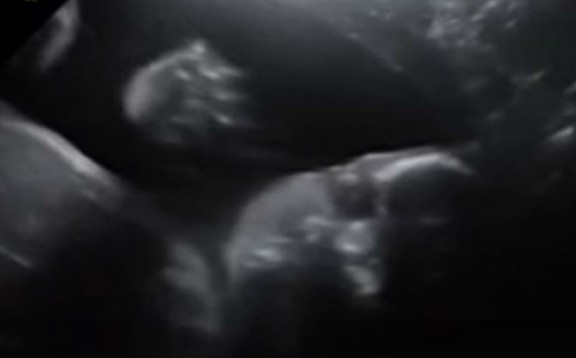 Έμβρυο χαιρετά τους γονείς του από το υπερηχογράφημα! - Φωτογραφία 1