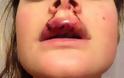 Σοκαριστικές φωτογραφ'ιες: Τυφλός από ζήλια παραμόρφωσε το πρόσωπο της κοπέλας του με δαγκωματιές - Φωτογραφία 5