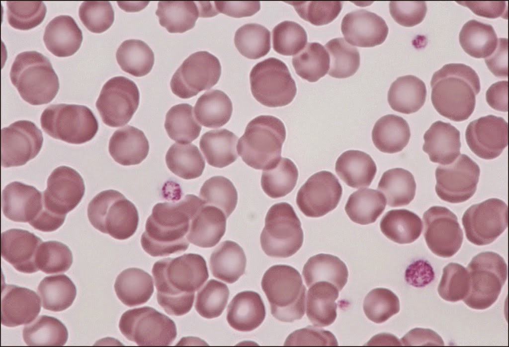 Χαμηλά αιμοπετάλια (θρομβοπενία) και αυξημένα αιμοπετάλια (θρομβοκυττάρωση). Που οφείλονται οι διαταραχές των αιμοπεταλίων - Φωτογραφία 2