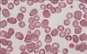 Χαμηλά αιμοπετάλια (θρομβοπενία) και αυξημένα αιμοπετάλια (θρομβοκυττάρωση). Που οφείλονται οι διαταραχές των αιμοπεταλίων - Φωτογραφία 2