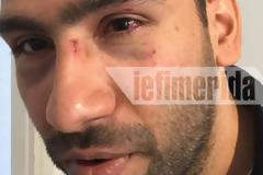 Τρόμος στου Φιλοπάππου -Ομάδα Ρομά επιτέθηκε, ξυλοκόπησε και λήστεψε παρέα