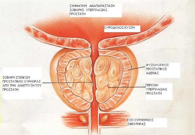 Ποιοι κινδυνεύουν από καρκίνο του προστάτη; - Φωτογραφία 2
