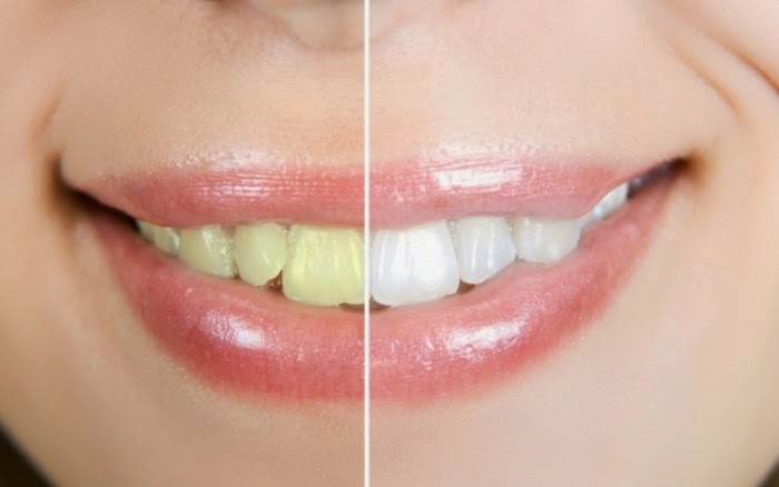 Τέσσερις φυσικοί τρόποι για πιο λευκά δόντια... - Φωτογραφία 1