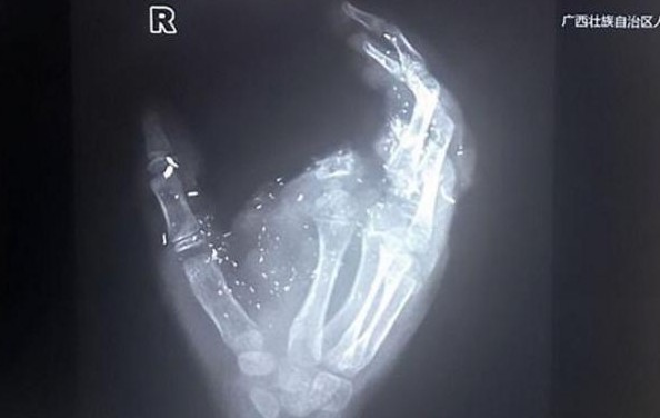 Δωδεκάχρονος έχασε ένα δάχτυλο και την όρασή του από έκρηξη κινητού [Video] - Φωτογραφία 1