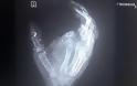 Δωδεκάχρονος έχασε ένα δάχτυλο και την όρασή του από έκρηξη κινητού [Video]