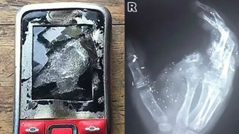 Ένα άτυχο αγόρι έχασε την όρασή του από το ένα μάτι και ένα δάχτυλο όταν το κινητό του που ήταν στην φόρτιση εξερράγη. - Φωτογραφία 1