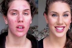 Μακιγιάζ που εξαφανίζει την ακμή