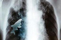 AΠΙΣΤΕΥΤΟ – ΔΕΙΤΕ: Ζωντανό ψάρι κολυμπούσε στον πνεύμονα έφηβου!