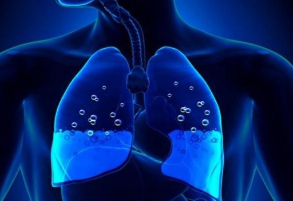 Πνευμονικό οίδημα: Τα σημάδια που δείχνουν συσσώρευση υγρού στον πνεύμονα! - Φωτογραφία 1