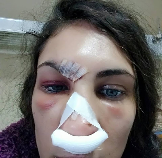 Ναστάζια Μητροπούλου: Σοκάρουν οι φωτογραφίες του γνωστού μοντέλου από το νοσοκομείο - Τι συνέβη; - Φωτογραφία 3